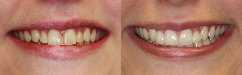 Dr. Jennifer Wallace. Palmetto Smiles of Beaufort. TMD, TMJ, Clear Aligners (SureSmile + Invisalign), Dental Implants, Sleep Apnea, Childrens Dentistry, Cosmetic Dentistry, Restorative Dentistry, General, Cosmetic, Restorative, Emergency Dentistry. Dentist in Beaufort, SC 29907