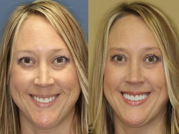 Dr. Jennifer Wallace. Palmetto Smiles of Beaufort. TMD, TMJ, Clear Aligners (SureSmile + Invisalign), Dental Implants, Sleep Apnea, Childrens Dentistry, Cosmetic Dentistry, Restorative Dentistry, General, Cosmetic, Restorative, Emergency Dentistry. Dentist in Beaufort, SC 29907